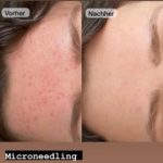 Green Peel Bodycareaesthetic Lippenpigmentierung Pigmentfleckenentfernung Microdermabrasion Microneedling Aquafacial Laserhaarentfernung Carbon Laser Permanent Make up Entfernung ( Augenbrauen ) Zahnbleaching Kräuterschälkur Bb Glow Radiofrequenz- Needling hanau Kosmetikstudio Beuty Salon