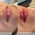 Green Peel Bodycareaesthetic Lippenpigmentierung Pigmentfleckenentfernung Microdermabrasion Microneedling Aquafacial Laserhaarentfernung Carbon Laser Permanent Make up Entfernung ( Augenbrauen ) Zahnbleaching Kräuterschälkur Bb Glow Radiofrequenz- Needling hanau Kosmetikstudio Beuty Salon