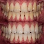 Green Peel Bodycareaesthetic Lippenpigmentierung Pigmentfleckenentfernung Microdermabrasion Microneedling Aquafacial Laserhaarentfernung Carbon Laser Permanent Make up Entfernung ( Augenbrauen ) Zahnbleaching Kräuterschälkur Bb Glow Radiofrequenz- Needling hanau Kosmetikstudio Beuty Salon