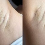 Green Peel Bodycareaesthetic Lippenpigmentierung Pigmentfleckenentfernung Microdermabrasion Microneedling Aquafacial Laserhaarentfernung Carbon Laser Permanent Make up Entfernung ( Augenbrauen ) Zahnbleaching Kräuterschälkur Bb Glow Radiofrequenz- Needling hanau Kosmetikstudio Beuty Salon