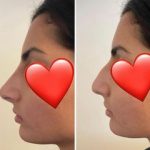 Green Peel Bodycareaesthetic Lippenpigmentierung Pigmentfleckenentfernung Microdermabrasion Microneedling Aquafacial Laserhaarentfernung Carbon Laser Permanent Make up Entfernung ( Augenbrauen ) Zahnbleaching Kräuterschälkur Bb Glow Radiofrequenz- Needling hanau Kosmetikstudio Beuty Salon