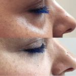 Green Peel Bodycareaesthetic Lippenpigmentierung Pigmentfleckenentfernung Microdermabrasion Microneedling Aquafacial Laserhaarentfernung Carbon Laser Permanent Make up Entfernung ( Augenbrauen ) Zahnbleaching Kräuterschälkur Bb Glow Radiofrequenz- Needling hanau Kosmetikstudio Beuty Salon