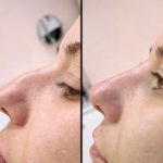 Green Peel Bodycareaesthetic Lippenpigmentierung Pigmentfleckenentfernung Microdermabrasion Microneedling Aquafacial Laserhaarentfernung Carbon Laser Permanent Make up Entfernung ( Augenbrauen ) Zahnbleaching Kräuterschälkur Bb Glow Radiofrequenz- Needling hanau Kosmetikstudio Beuty Salon