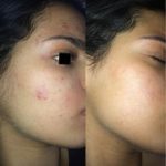 Green Peel Bodycareaesthetic Lippenpigmentierung Pigmentfleckenentfernung Microdermabrasion Microneedling Aquafacial Laserhaarentfernung Carbon Laser Permanent Make up Entfernung ( Augenbrauen ) Zahnbleaching Kräuterschälkur Bb Glow Radiofrequenz- Needling hanau Kosmetikstudio Beuty Salon